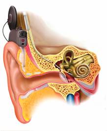 Freedom Scope - Cochlear Implant